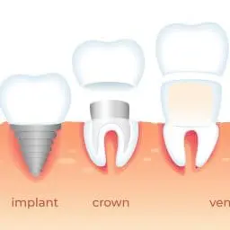 implant veneers crowns