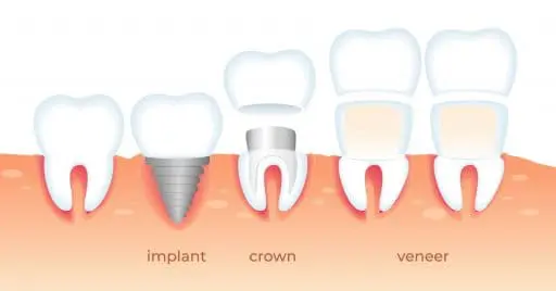 implant veneers crowns