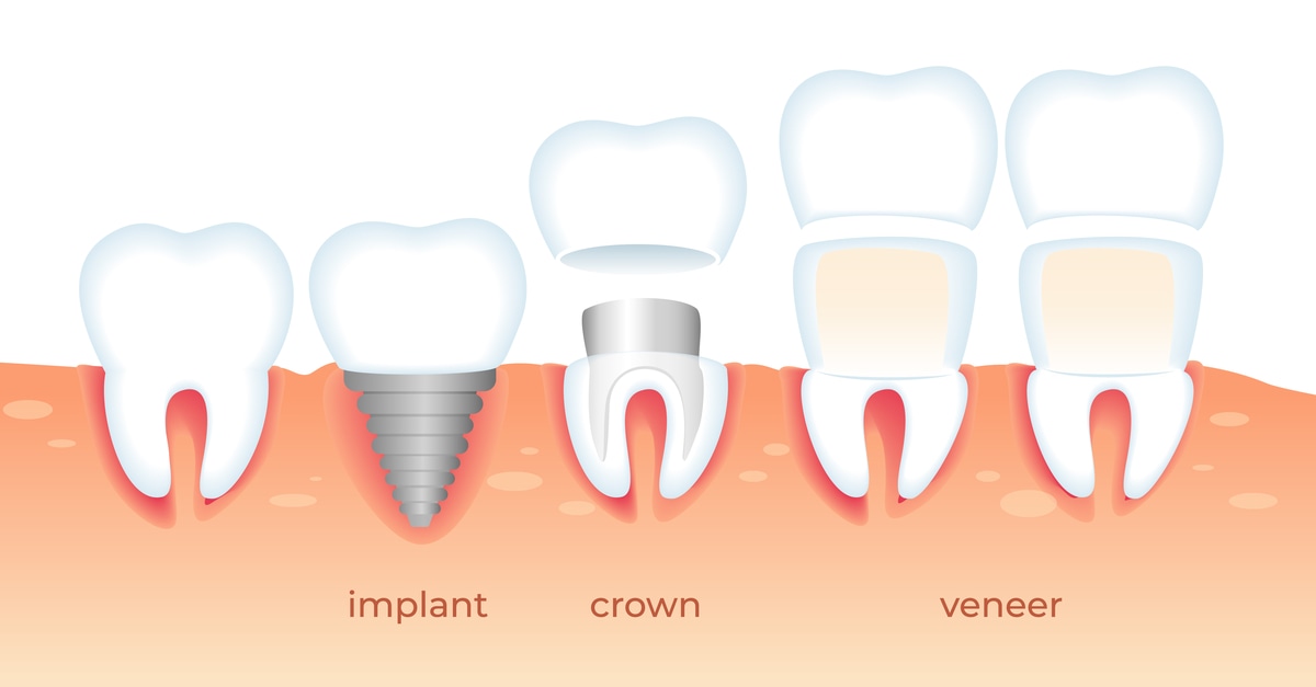 Can You Get Veneers If You Have Dental Implants?